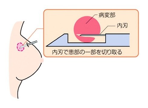 超音波下針生検 | 検査について | 京都の乳腺外科｜京都ブレスト